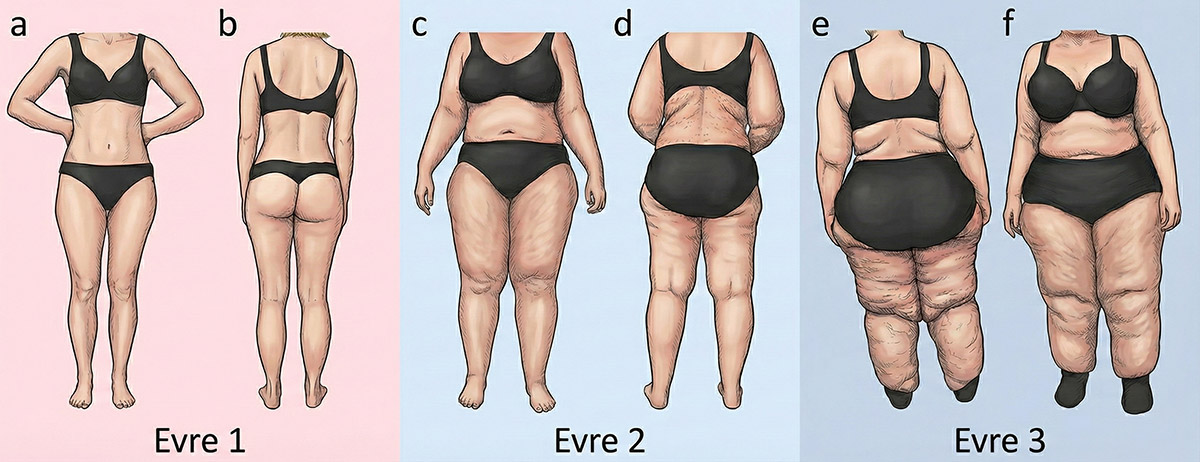 Lipödem Evreleri